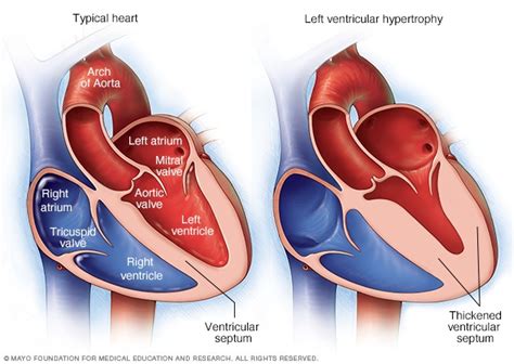 Hypertrophy: Definition, Causes, Physiologic Hypertrophy, Pathologic ...