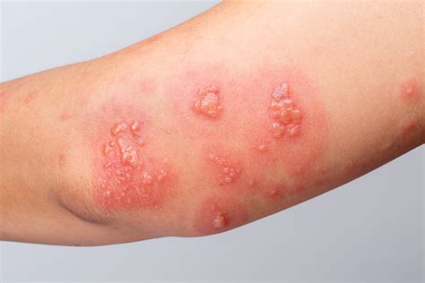 O Que Causa A Herpes Zoster - Herpes-zóster: o que é, sintomas, causas e tratamento - Imunovida