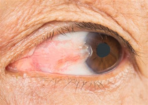Rare Eye Diseases - Low Vision Aids