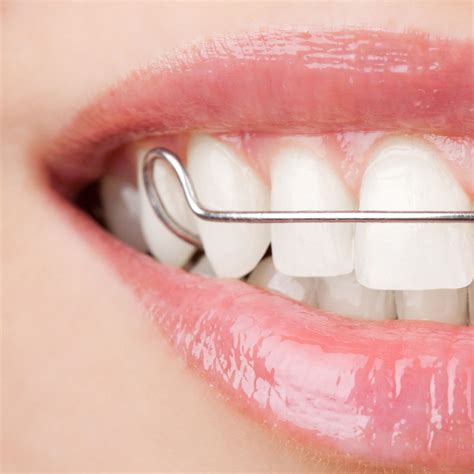 retainers moray orthodontics