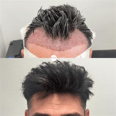 clinic hair transplant 3
