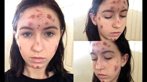 treat chemical burn  face products  paul boldt blog