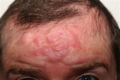 rosacea  symptoms cream diet rosacea treatment