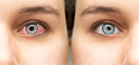 Signs of A Bacterial Eye Infection | Lancaster, PA | Campus Eye Center