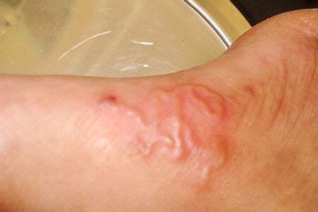 how to know if i have worms in my body