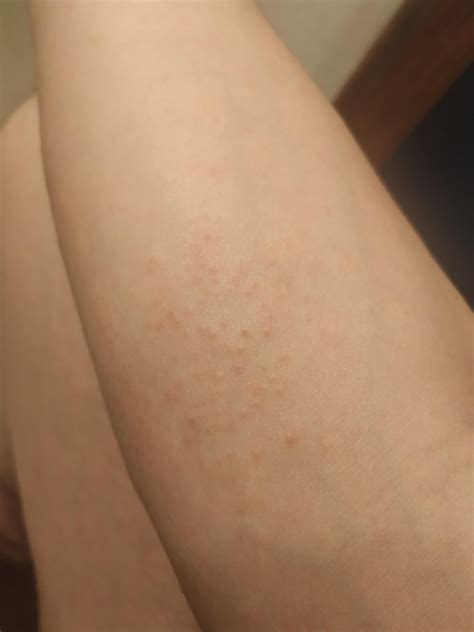 itchy mystery bumps on legs and forearms. thought it was hives, but has