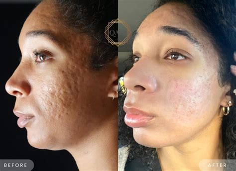 acne scars  pih  africanblack skin