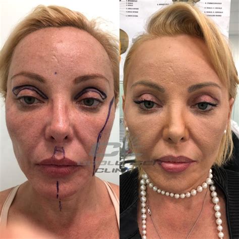 Пластика носа Киев ️ Цена на пластику носа в Coolaser Clinic