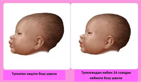 Вытянутая голова у новорожденного