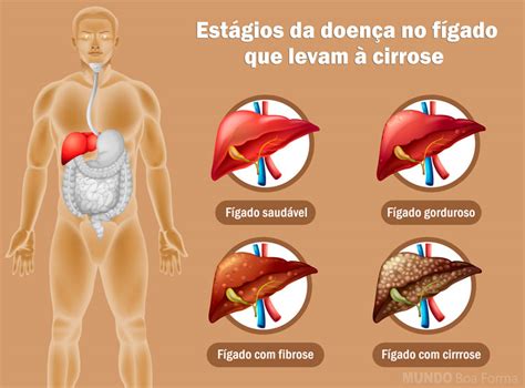 Jaca Faz Mal Para O Fígado - 13 alimentos ruins para o fígado - MundoBoaForma