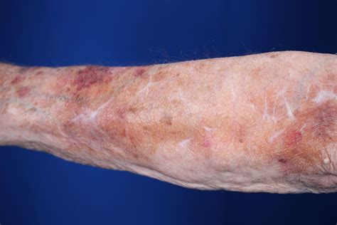 This patient has thinning skin which is skin that tears, bruises, or ...
