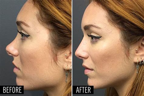 plastic surgeon    nose job happen   minutes