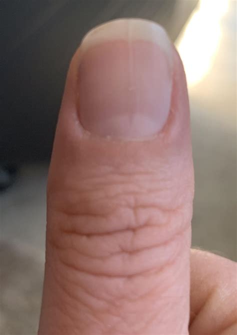 My thumb nail mysteriously grew a split in the middle that coincides
