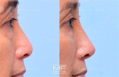 Non Surgical Rhinoplasty Before and After Pictures Case 1109 | San
