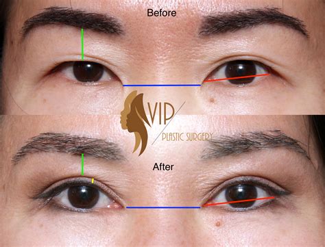Eyelid Lift