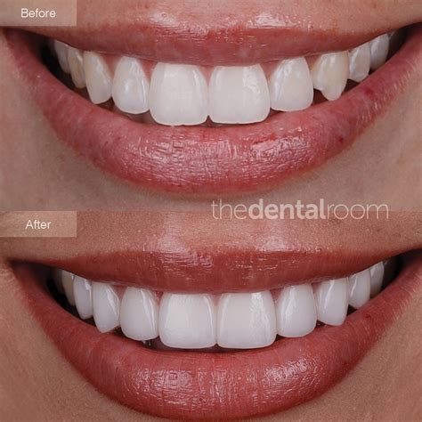 porcelain veneers  improve     strength