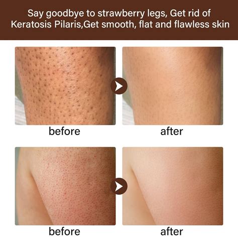 How To Get Rid Of Strawberry Legs