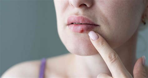 Cold Sores: Types, Symptoms, Causes, Diagnosis, Treatment, and More