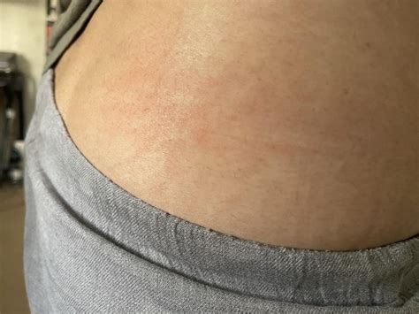 Hi fam - anything to worry about? (Itch/rash) : r/lamictal