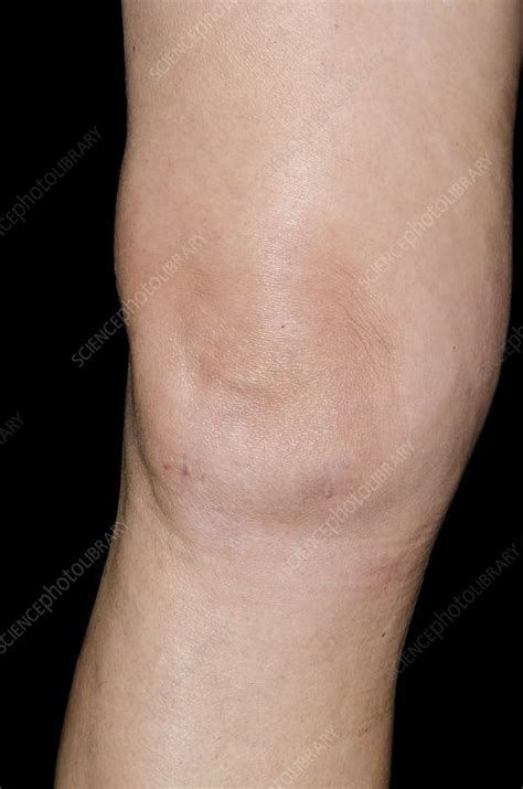 effusion   knee  surgery stock image  science