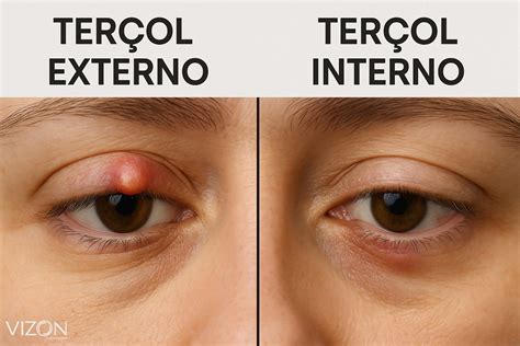 O Que É Bom Pra Tersol - 5 Tratamentos e medicamentos para terçol no Olho