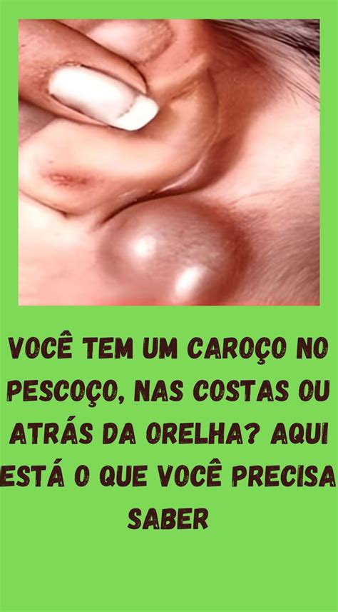 Caroço Atrás Da Orelha No Osso - Você tem um caroço no pescoço, nas costas ou atrás da orelha? Aqui está ...