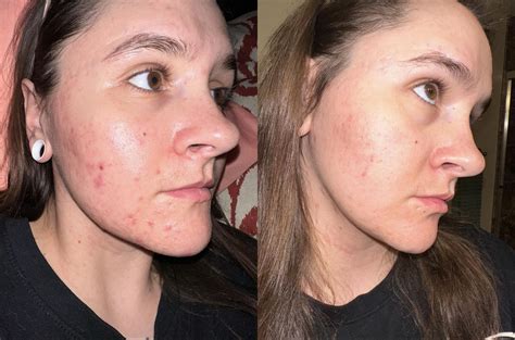 how long for tretinoin to work 4