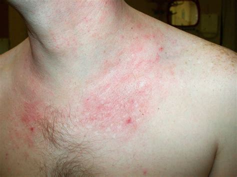 Atopic dermatitis causes, symptoms, diagnosis, treatment & prognosis