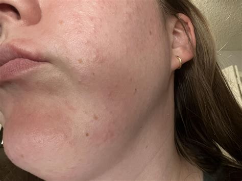 Discover more like SkincareAddicts: Allergic reaction maybe? and