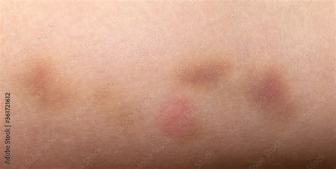 closeup bruise  human skin   background stock photo adobe stock