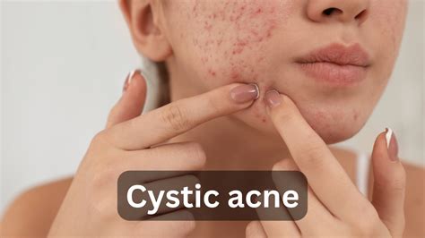 Understanding Cystic Acne: Causes, Symptoms, and Treatment Options