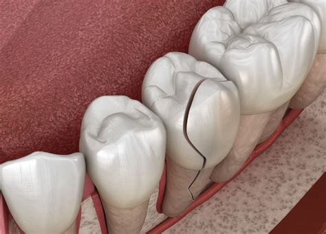 Fixing A Chipped Tooth: Prices That May Chip Your Budget