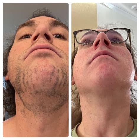 laser hair removal for face price 5