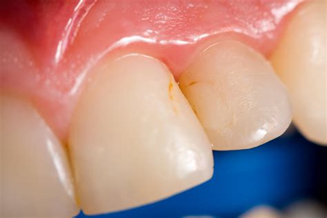 How To Reduce Teeth Staining at Harold Case blog