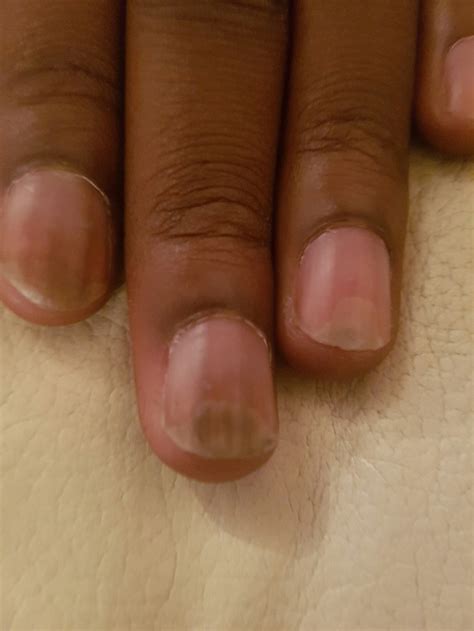 Case report: photo‐onycholysis after PUVA treatment for hypopigmented