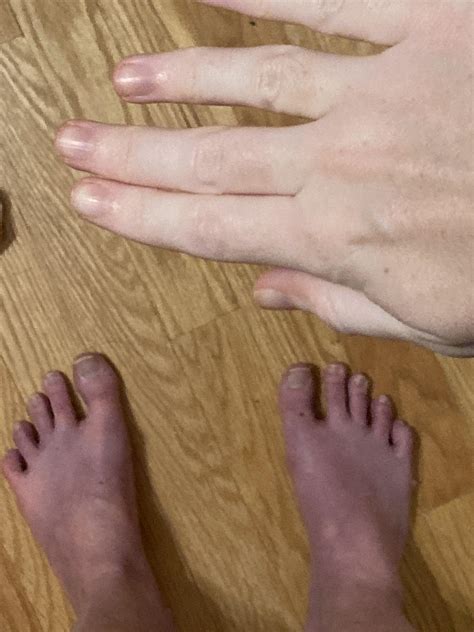 Circulation issues specifically in my toes - Raynaud’s Syndrome : POTS