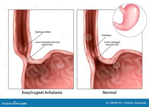 Esophagus Sphincter Anatomy