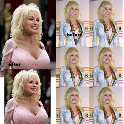 Dolly Parton Breast Implants Size Before & After - Celebrity ...