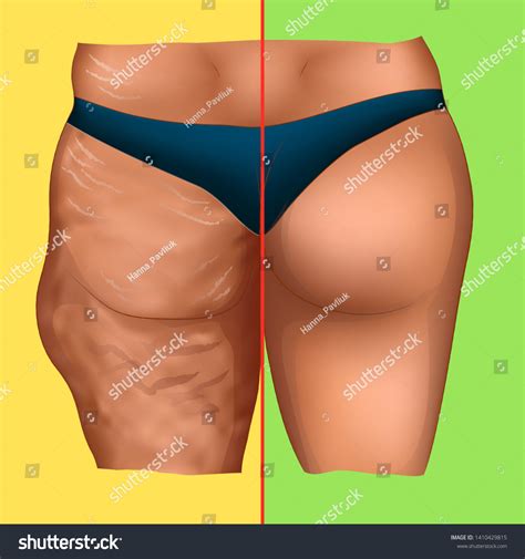 Cellulite On Woman Buttocks Before After: vector de stock (libre de
