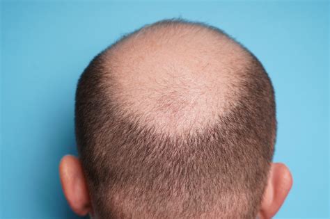 humans  bald discover magazine