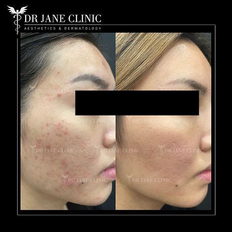 acne treatment dr jane clinic