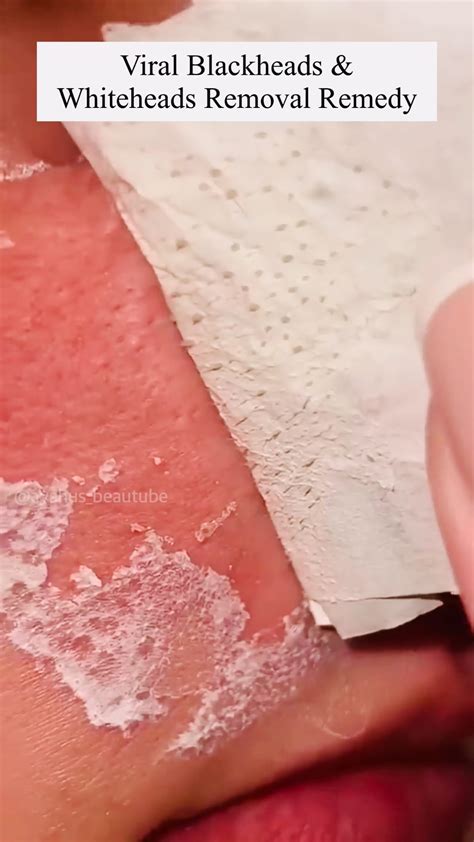 Unbelievable Blackhead Removal 2024: Don't Make This Mistake! Image 9