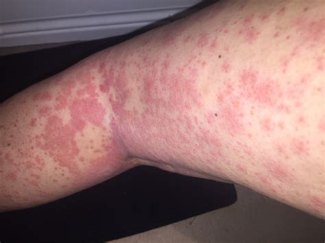 Skin Early Inflammatory Breast Cancer Rash Pictures : Rare Breast
