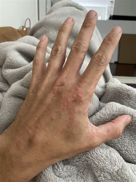 Bumps On Fingers