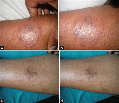 (a) Terbinafine treated (T. Corporis) Baseline. (b) Terbinafine-75% ...