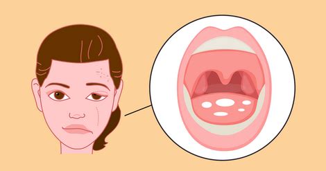 Myasthenia Gravis vs. Lambert-Eaton: 3 Differences and 3 Similarities ...