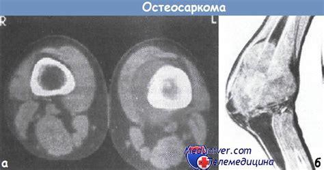 Клиника и диагностика остеосаркомы