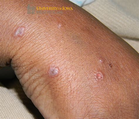 Many pink papules and vesicles, some with central erosion and