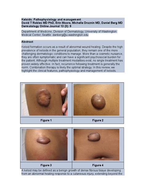 Keloid S | PDF | Scar | Wound Healing