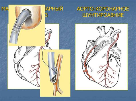 Хирургическое лечение ишемической болезни сердца - презентация онлайн